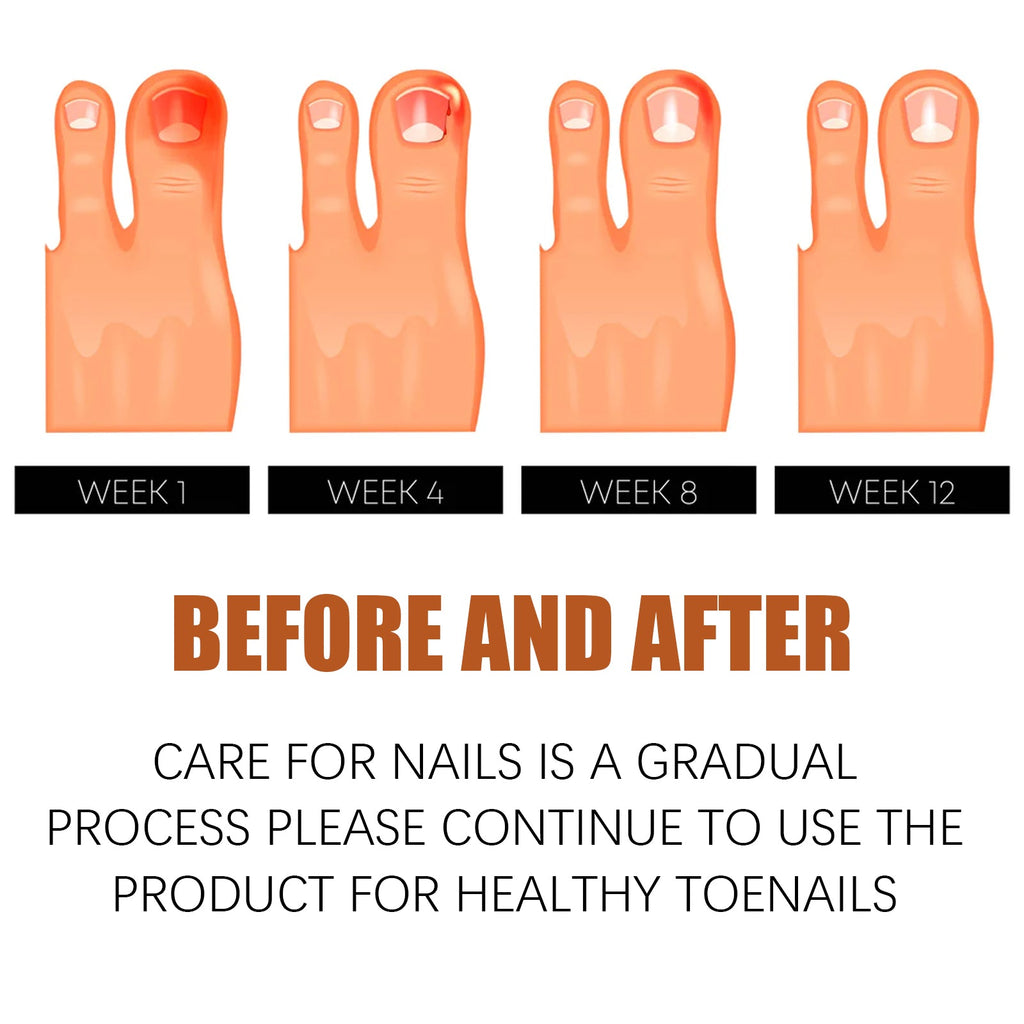 Anti-Nail Groove Relief Oil, Repair Inlaid Nails Gray Nails And Soft Thickening Nail Brightening Nails Care Oil